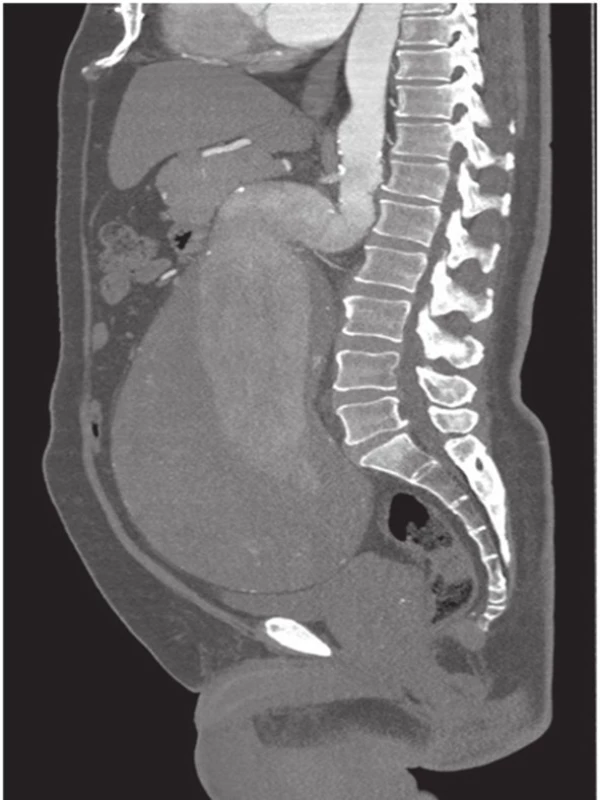 CT AG gigantického AAA ve frontální rovině
Fig. 2. CT AG of giant AAA in the frontal plane