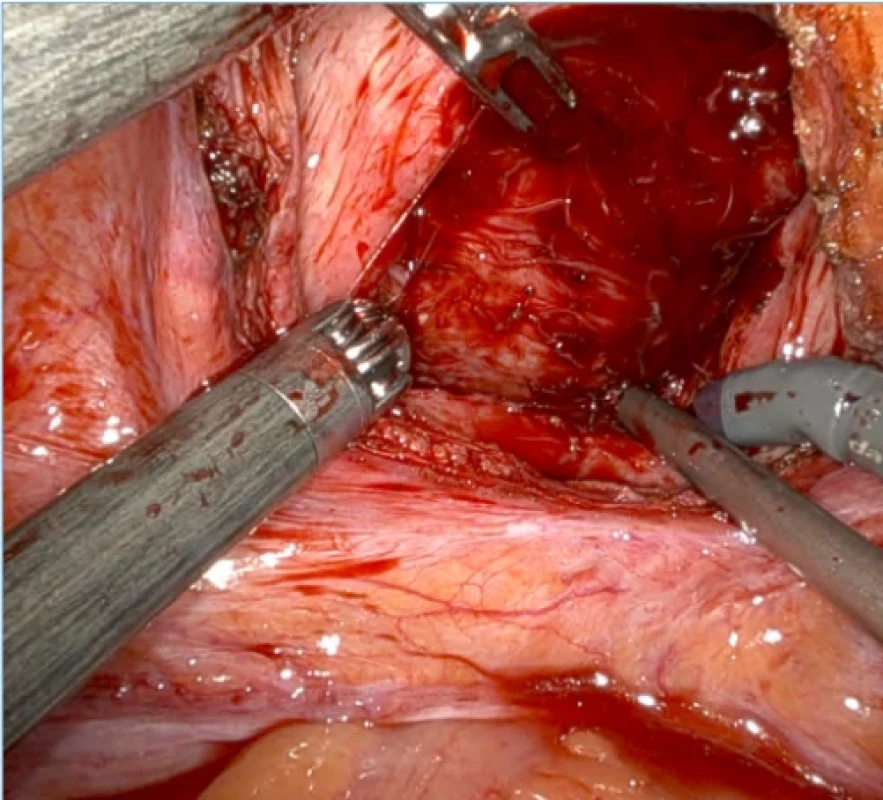 Transvezikální přístup robotické simple prostatektomie. Fig. 2. Transvesical approach to robotic simple prostatectomy. 