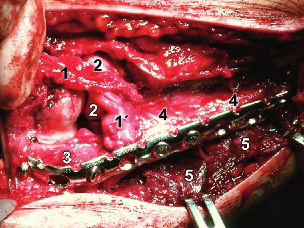 Rozšířený modifikovaný Kocherův přístup – situace po dokončení osteosyntézy (srovnej s Obr. 18): 1 – lig. collaterale lat., 1´– lig. collaterale lat. ulnare, 2 – hlavice radia, 3 – olekranický fragment ulny, 4 – diafyzární fragment ulny, 5 – m. flexor carpi ulnaris.
Fig. 19: Extended modified Kocher approach – after completion of internal fixation (compare with Fig. 18): 1 – lateral collateral ligament, 1´ – lateral ulnar collateral ligament, 2 – radial head, 
3 – olecranon fragment of ulna, 4 – diaphyseal fragment of ulna, 5 – flexor carpi ulnaris.