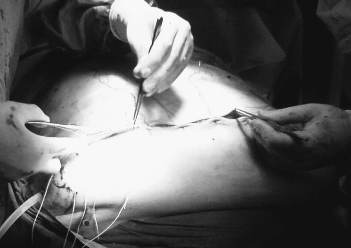 Korekcia a plastika brušnej steny
Fig. 4. Correction and plastic surgery of the abdominal wall
