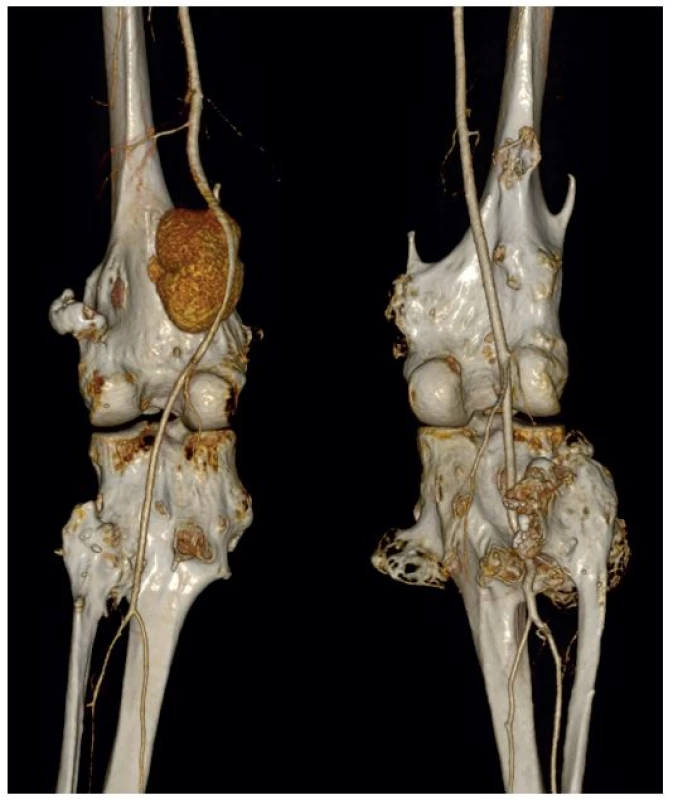 CT angiografie, VRT (Volume Rendering Technique) snímky
Fig. 2: CT angiography, VRT (Volume Rendering Technique) images