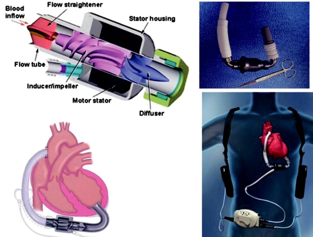 Implantovatelné mechanické podpory s kontinuálním průtokem
Vlevo – MicroMed DeBakey VAD; vpravo – systém Thoratec-HeartMate II