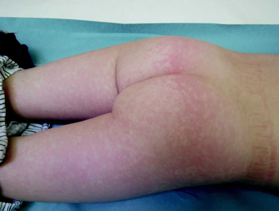 Erythema infectiosum, 9-ročný chlapec (parvovírus B19)