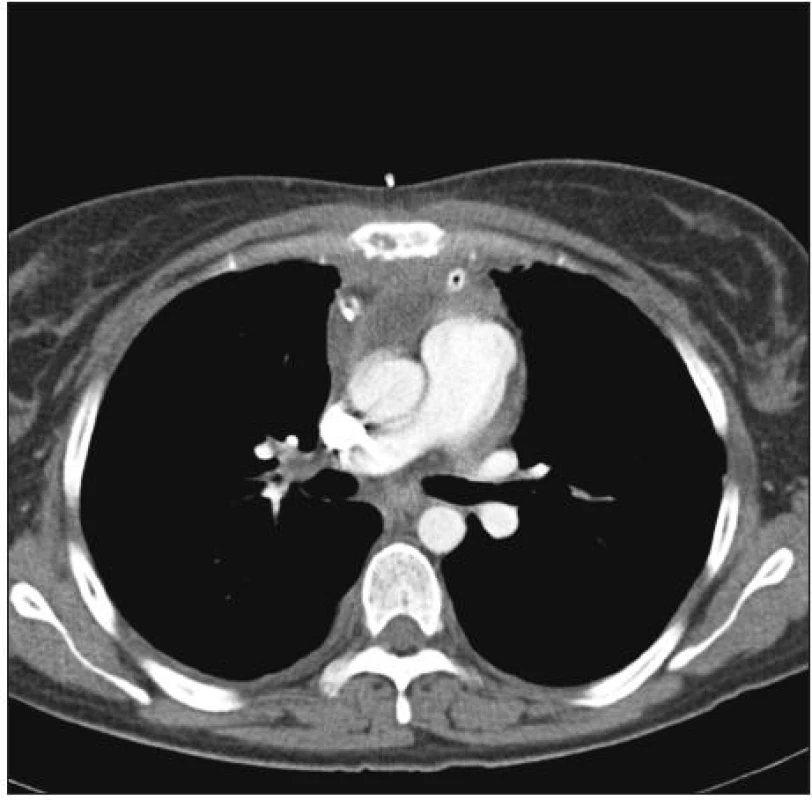 Sternumosteomyelitis mit Fraktur im kranialen Sternumdrittel und das Sternum umgebender Abszess (axialer Schnitt)