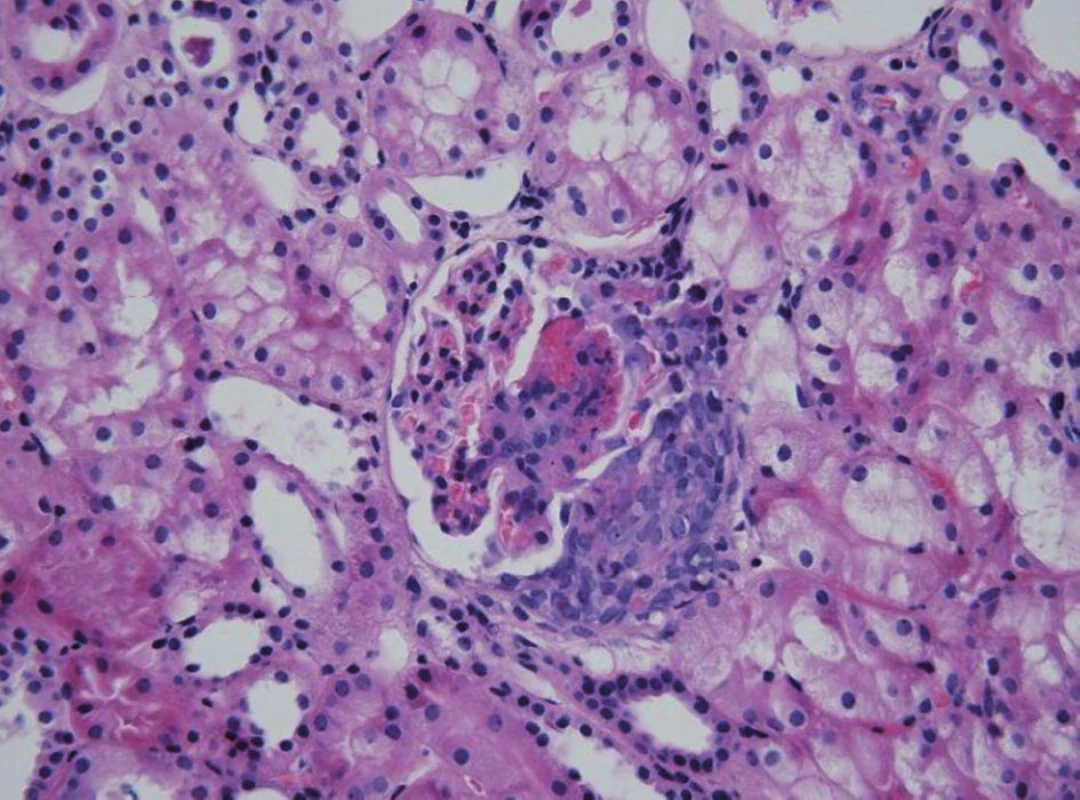 HSP nefritida. Přítomnost nekrózy a celulárního srpku v glomerulu u těžce probíhající formy HSPN.
Fig. 2. HSP nephritis. Glomerular necrosis and cellular crescent in severe HSP nephritis.