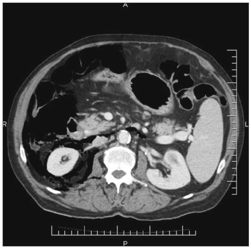 Perforace duodena s pneumoretroperitoneem
Fig. 2. Duodenal perforation with pneumoretroperitoneum