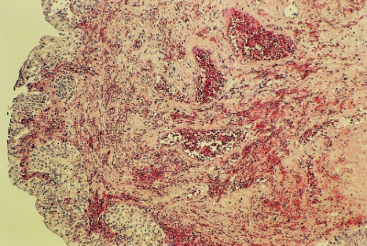 Překrvený a jemně prokrvácený polyp na povrchu krytý urotelem (barvení HE, zvětšení 25×)