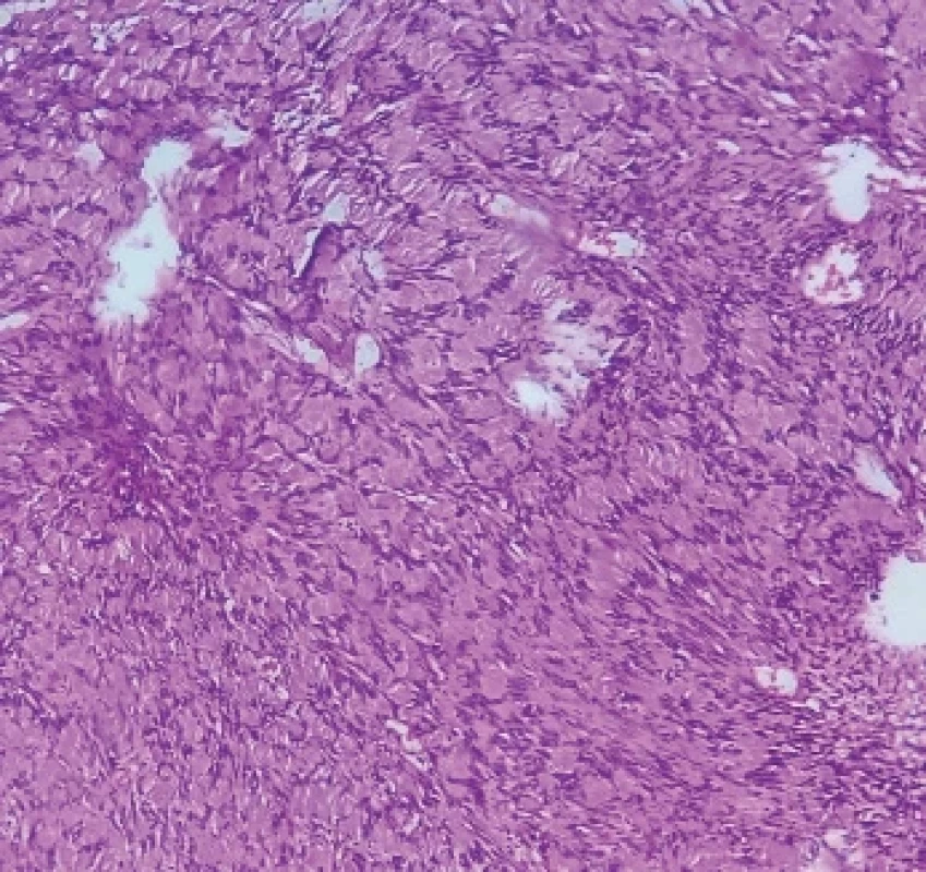 This image shows verocay bodies including the palisading of the schwann cells nuclei with an arrangement in rows and separated by pinkish fibrillary processes. H & E: Hematoxillin and Eosin