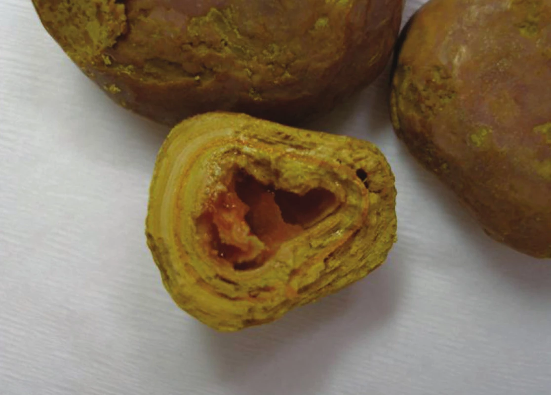Konkrementy nalezené v ileu
Fig. 3: Concrements found in the ileum
