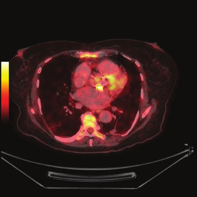 FDG PET/CT z 19. 10. 2012
2a - předozadní MIP, v okolí sleziny patrné drobné hyperaktivity - fraktury žeber (šipky)
2b - PET s korekcí na atenuaci, axiální řez srdcem v úrovni aortálního anulu (ve stejné rovině jako 1b), jsou patrné dva okrsky výrazněji zvýšené akumulace FDG v oblasti aortálního anulu (šipky)
2c - PET bez korekce na atenuaci, axiální řez ve stejné rovině jako 2b
2d - fúze PET/CT, axiální řez v rovině odpovídající 2b
