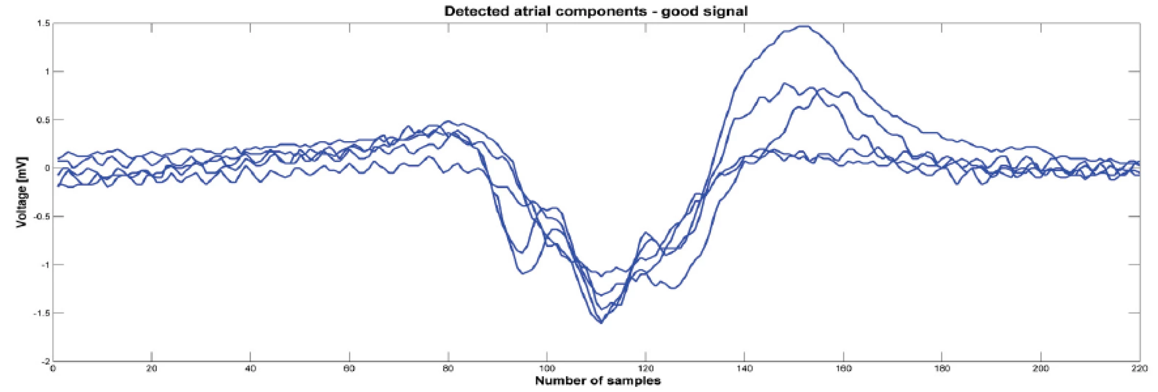 Detected atrial components from one signal before ablation that was classified as good. Atrial components were synchronized by minimas.