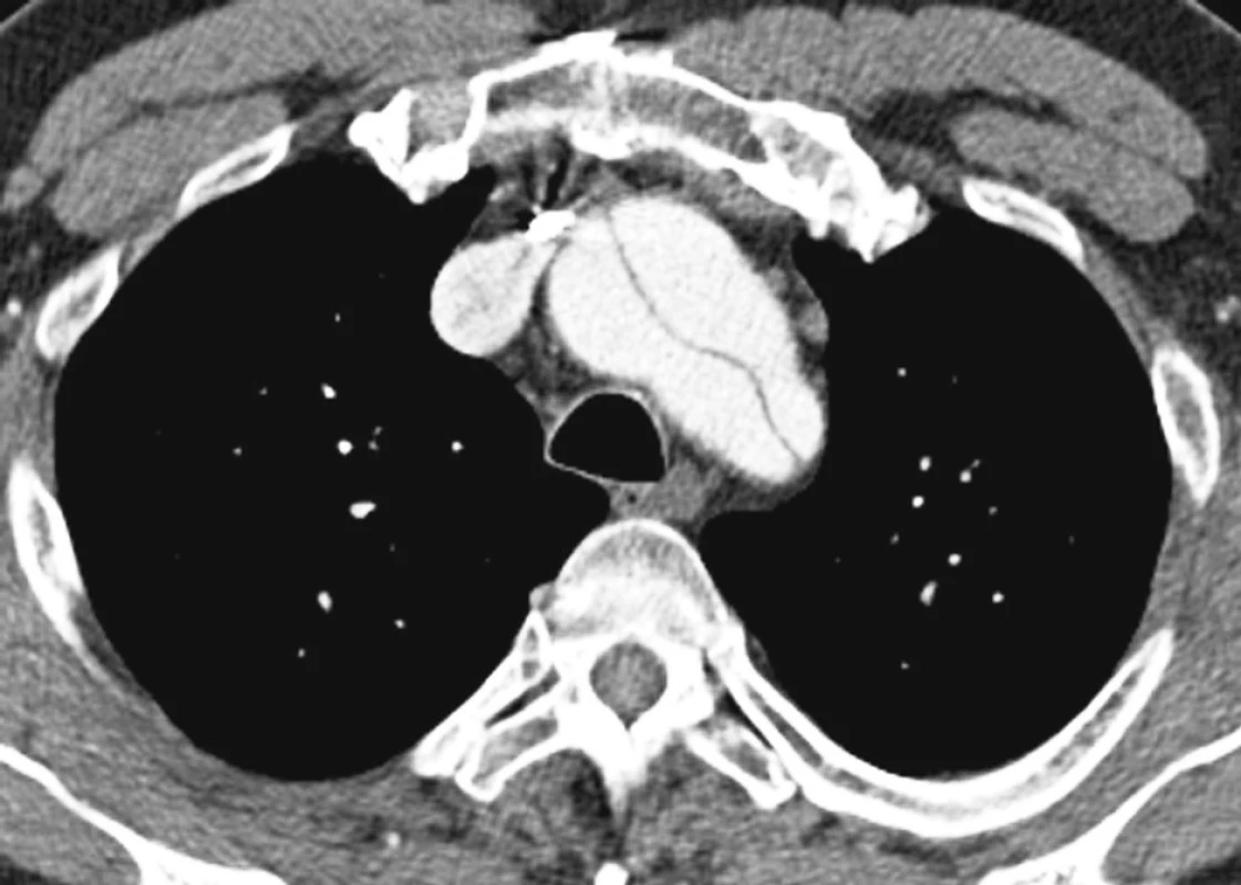 CTAobraz disekce hrudní aorty po náhradě ascendentní aorty
Pic 12. A CTA view of the thoracic aorta dissection following implantation of the ascendent aorta
