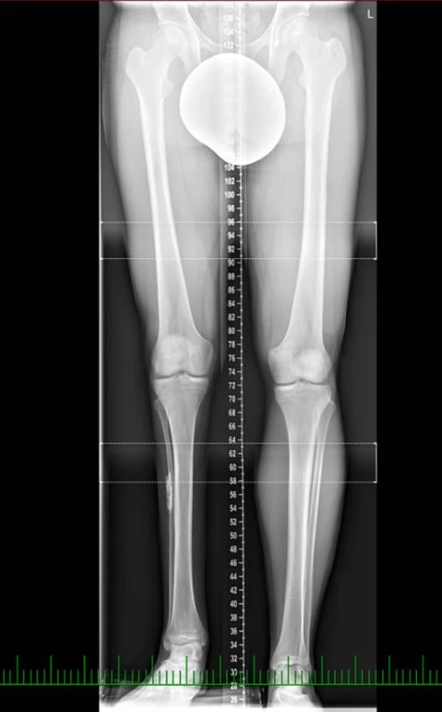 Rtg nález před subtrochanterickou abreviační osteotomií femuru
