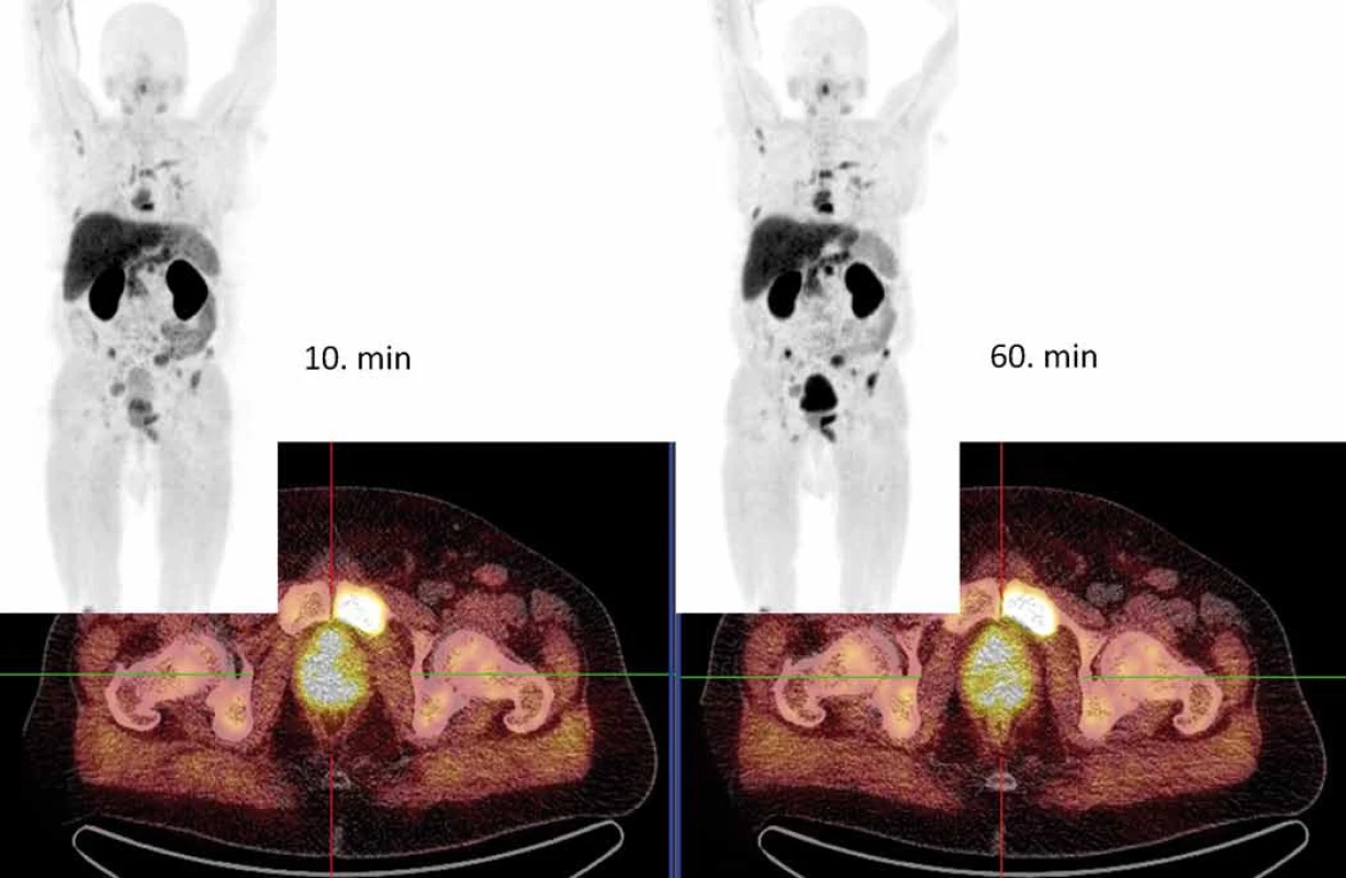 [<sup>18</sup>F]fluorocholin-PET/low-dose CT.
Vyšetření v 10. min od aplikace radiofarmaka lépe prokazuje zvýšenou akumulaci fluorocholinu v primárním karcinomu prostaty (lokalizační kříž), naopak mnohočetné kostní metastázy jsou lépe patrny při vyšetření v 60. min.