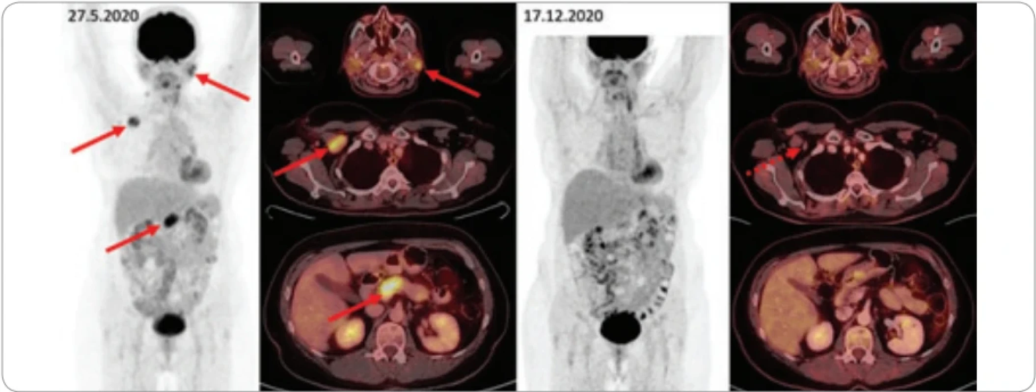  Pacientka (ročník 1958) měla v roce 2013 opakované biopsie krční lymfadenopatie se závěrem nespecifické zánětlivé projevy. Barvení na IgG4+ plazmocyty v té době nebylo prováděno. V roce 2020 provedli ve Zlíně biopsii axilární lymfadenopatie se závěrem IgG4-RD. Pro nález na pankreatu byla provedena punkční biopsie se závěrem zánětlivé změny odpovídající IgG4-RD. Po léčbě v roce 2020 kompletní remise, a tak pokračuje udržovací léčba. Na posledním FDG-PET/CT byla nalezena podkožní ložiska na pažích při jinak normálním nálezu. Z nich biopticky vyšel xantogranulom při jinak trvající remisi IgG4-RD. V roce 2025 trvá remise IgG4-RD a probíhá léčba xantogranulomu 2-chlorodeoxyadenozinem. Monitorace léčby pomocí 18F-FDG-PET/CT – vlevo iniciální sken (MIP PET snímané části těla a detaily v axiálních fúzovaný řezech), vpravo kontrolní sken. Šipkami jsou označeny metabolicky aktivní infi ltrace příušních slinných žláz, zvětšená aktivní uzlina vpravo pod prsními svaly, infiltrace přechodu hlavy a těla pankreatu. Další méně výrazná ložiska (vlevo v gll. submandibularis, uzlinách na krku, kaudě pankreatu) jsou patrna na MIP zobrazení, ale nejsou označena. Tato metabolicky aktivní ložiska při kontrolním vyšetření zanikají, drobné reziduum bez zvýšené metabolické aktivity je patrné jen vpravo submamárně.