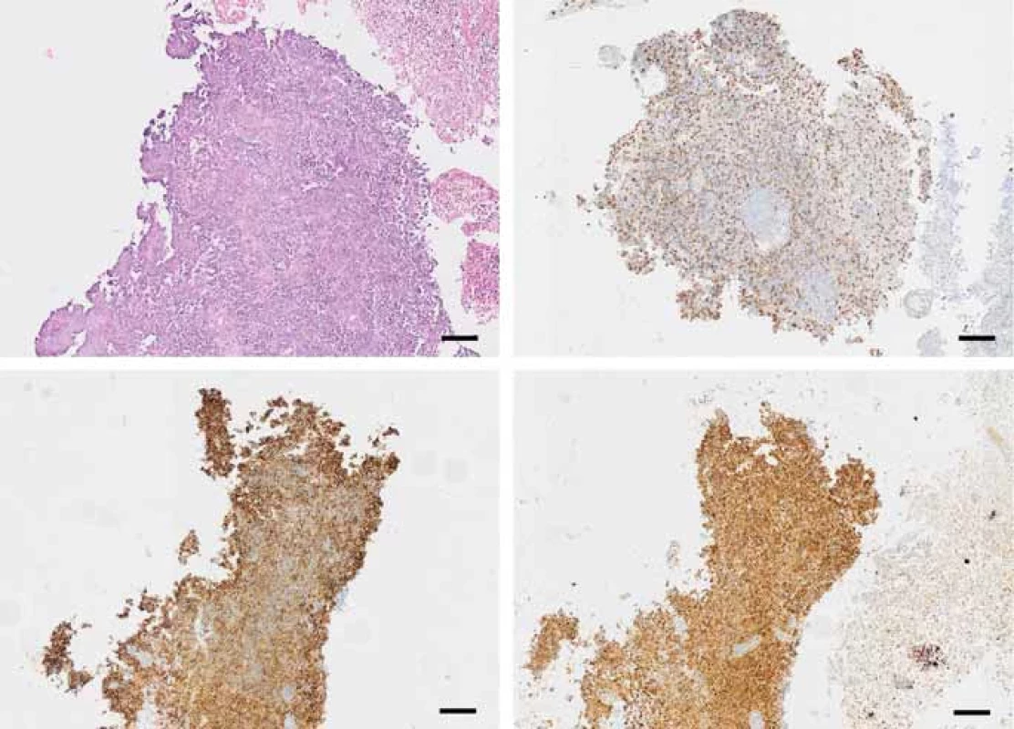Fragments of a tumor consisting of medium-sized cells with large hyperchromatic nuclei, coarse chromatin structure with abundant mitotic activity (A); immunohistochemistry, tumor cells express vimentin (B); CD99 (C); neuron specifi c enolase (scale bar 100 μm) (D).