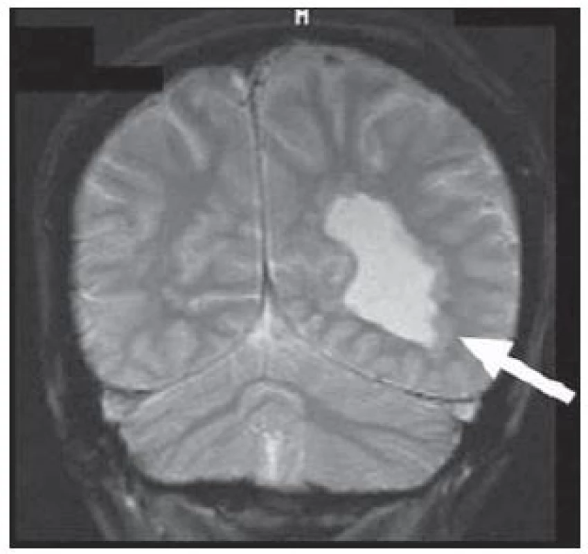 Hemimegalencefalie.