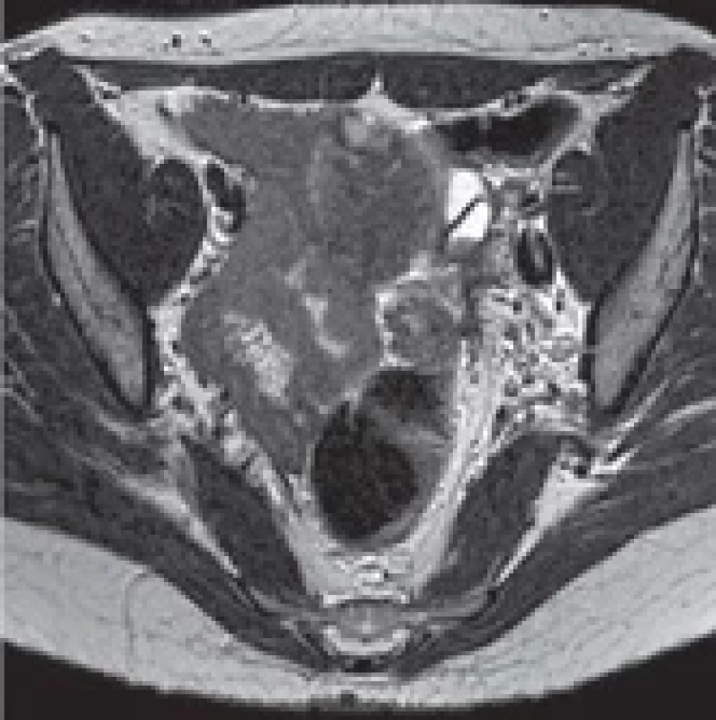 Axial T2-weighted MRI detecting a left ovarian endometrioma with shading eff ect on the left (hypointense level descending from hemoglobin degradation products) and paraovarian endometriosis infi ltrating the sigmoid colon (blue arrows).