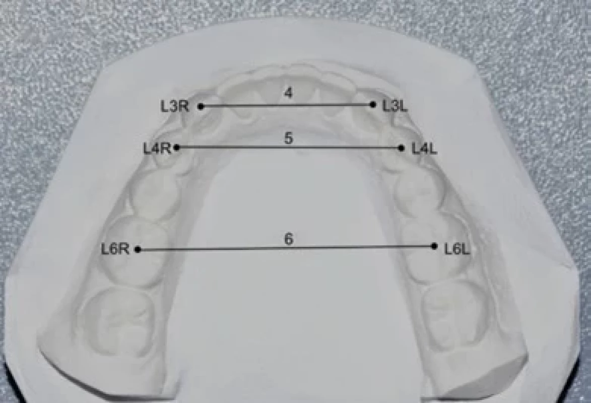 Sádrový odlitek a způsob měření. 4 – vzdálenost mezi hroty dolních špičáků L3L a L3R (mm), 5 – vzdálenost mezi hroty vestibulárních hrbolků prvních dolních premolárů L4L a L4R (mm), 6 – vzdálenost mezi středem meziodistální okluzní rýhy prvních dolních molárů L6L a L6R (mm). Inspirováno [32].