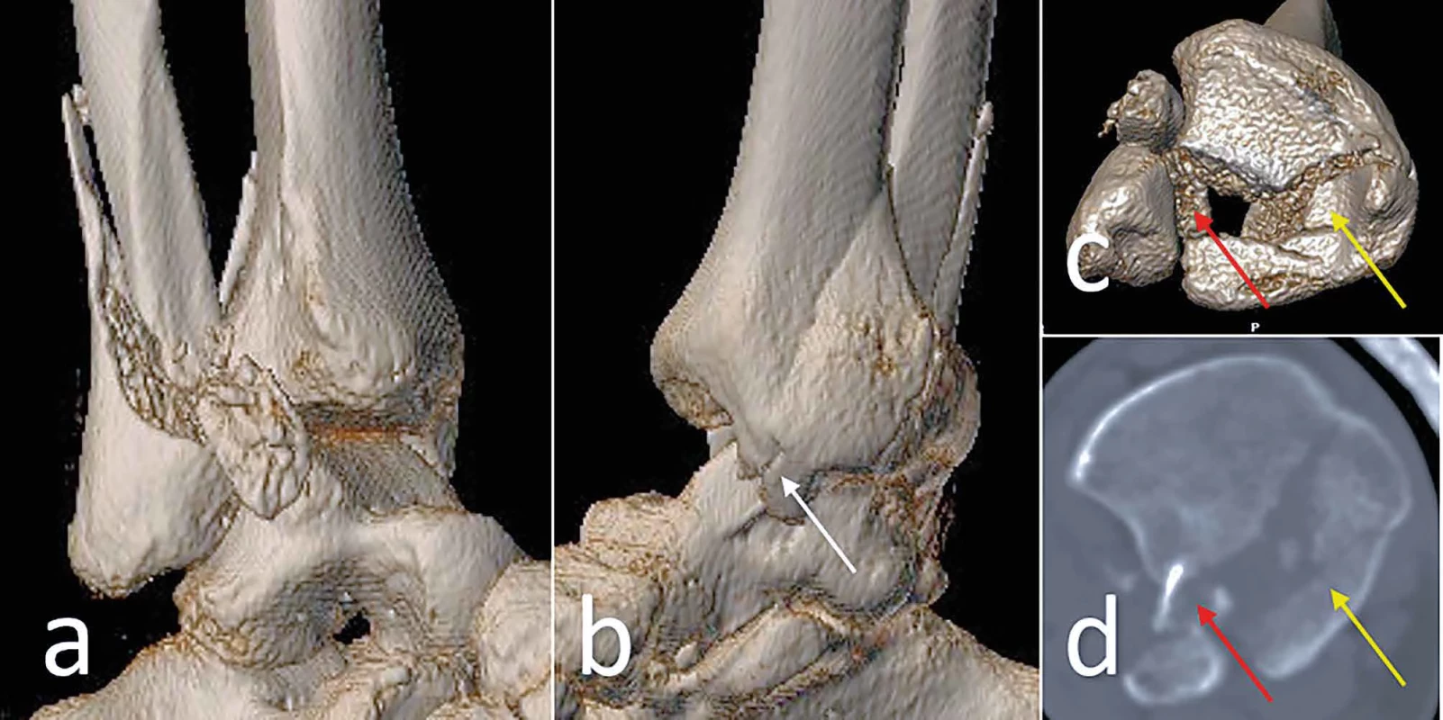 Bosworthova zlomenina spojená s parciální posteromediální zlomeninou pilonu </br> Bosworth fracture associated with a partial posteromedial fracture of the pilon