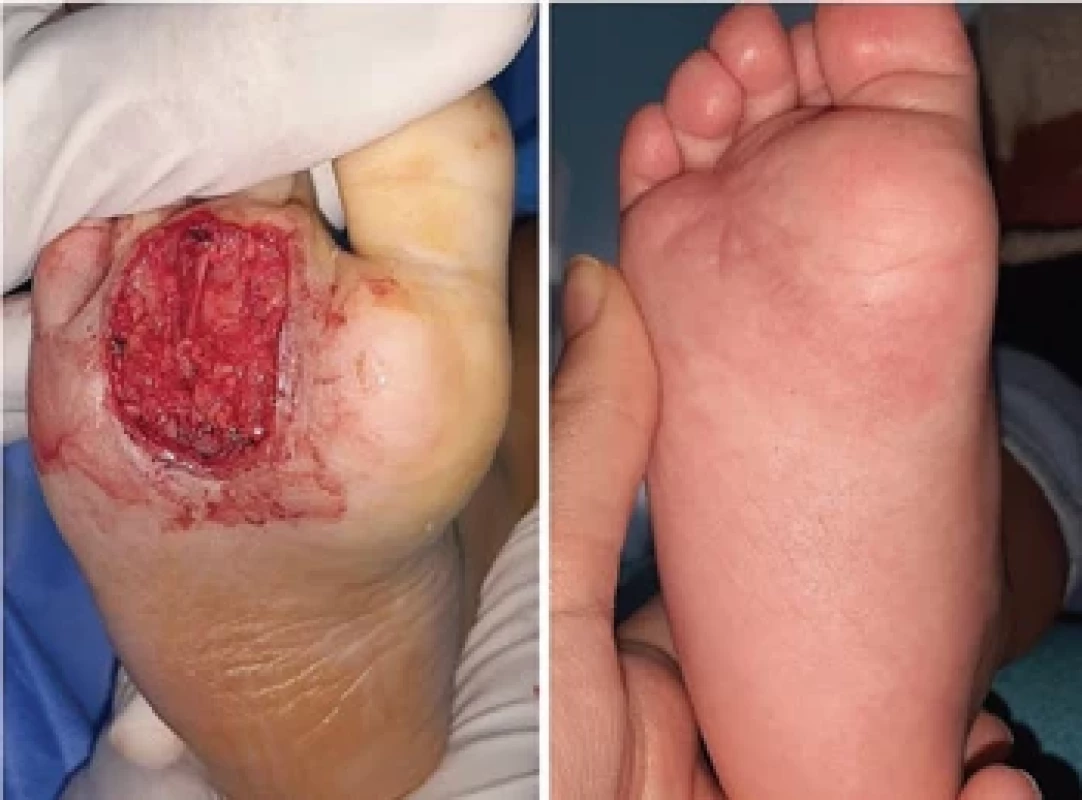 From left to right – after excision of the tumor leaving a minor residue, aspect after 6 months follow-up.