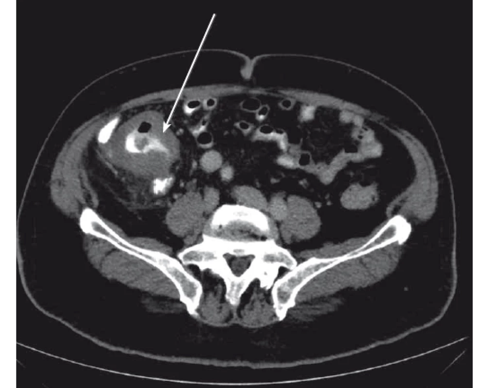Zesílení stěny céka zánětlivým infiltrátem (šipka).
Fig. 1. Inflammatory swelling of the cecal wall (arrow).