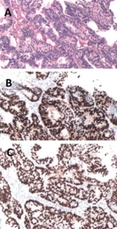 A) Soft tissues and bone of the sacral region infi ltrated by adenocarcinoma (HE, 400×); B) Immunohistochemistry showing diff use nuclear positivity for PAX-8 (400×); C) Immunohistochemistry showing diff use nuclear positivity for estrogen receptors (400×).