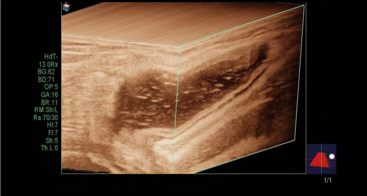 Vzorový echografický synovialogram stadium tertium. Obraz sonografického vyšetrenia recessus suprapatellaris pri prítomnosti detrituálneho exsudátu – 3D rekonštrukcia recesu, kvantitatívny echografický synovialogram štádium gama-γ. Fig. 3. Sample of the echosynovialgram grade III. Ultrasound image of the presence of fluid collections – detritus exudate, 3D reconstruction of the recess, and quantitative echosynovialgram grade gamma-γ.