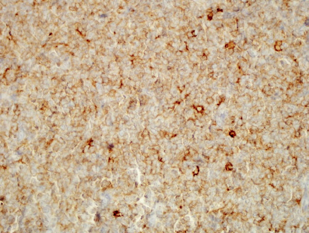 Pozitivita CD4+ v infiltráte (zväčšenie 20x).