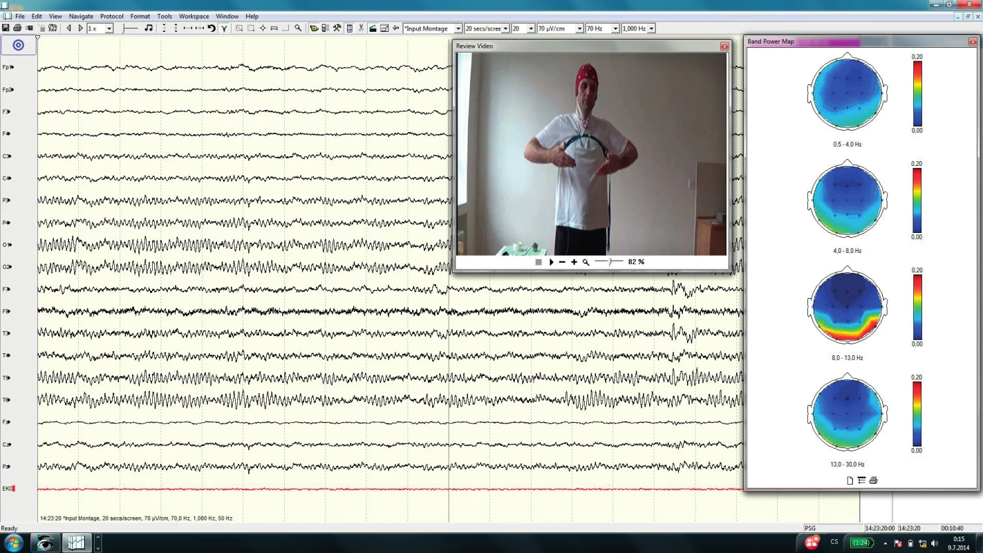 Ukázka cvičení při zavřených očích, v EEG se objevuje alfa aktivita nad zadními kvadranty. Frekvenční brain mapping zobrazuje topografické rozložení alfa aktivity v okcipitálních oblastech.