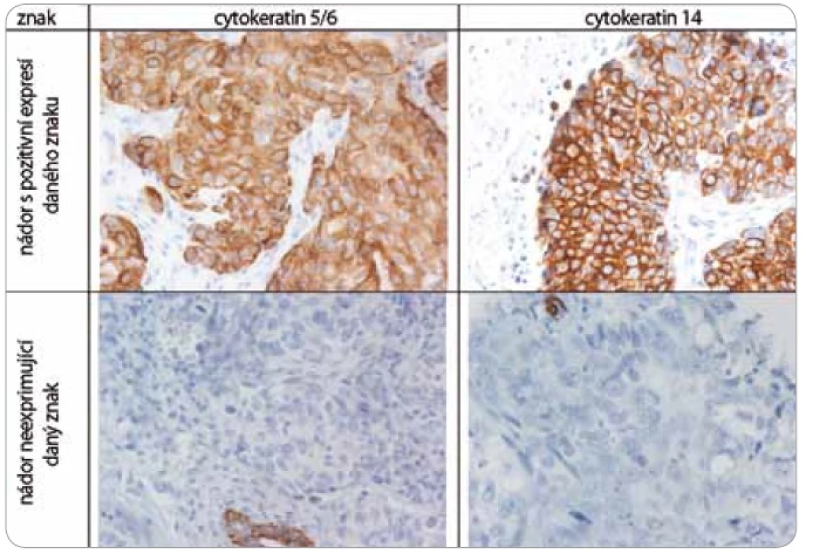 Imunohistochemické vyšetření sledovaných znaků v nádorové tkáni karcinomů prsu.