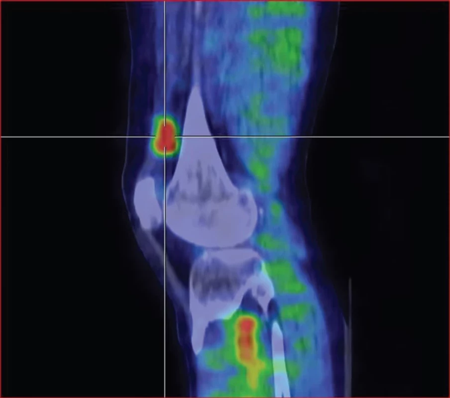 SPECT/CT pravého kolenního kloubu v časné fázi v sagitálním řezu – zvýšený krevní pool v oblasti odpovídající suprapatelární burze.