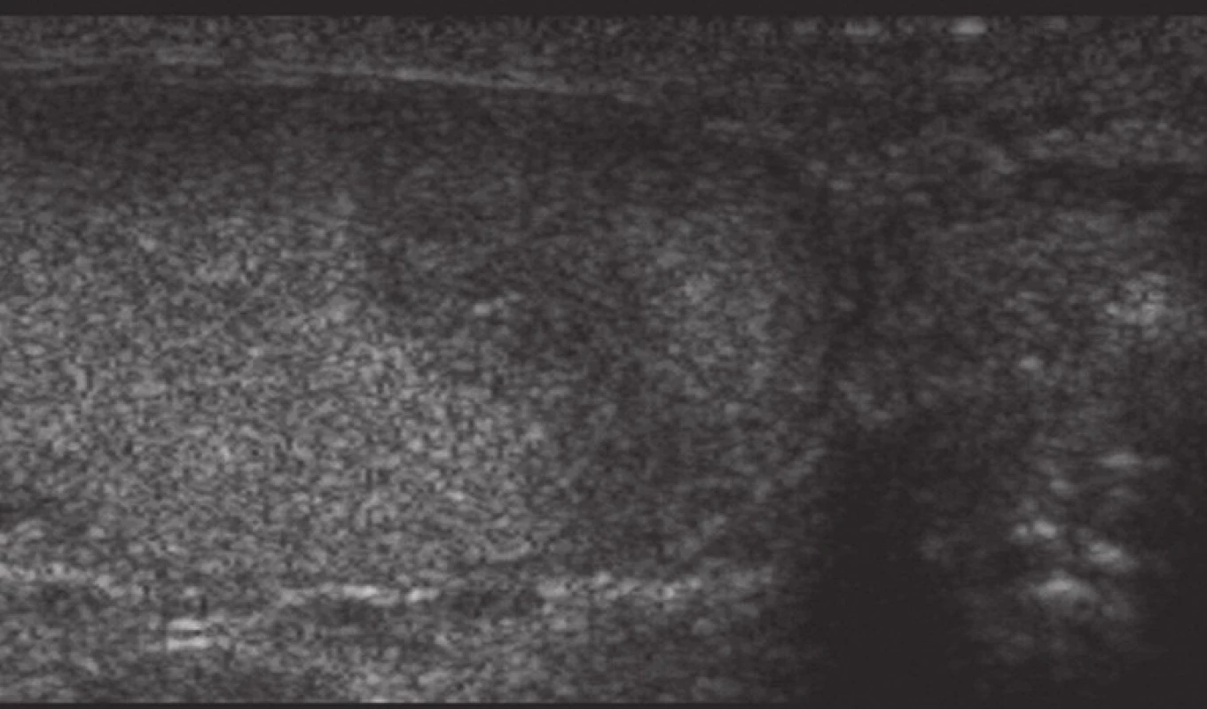 Sonografický obraz lézie v oblasti dolného pólu pravého testis. Išlo o neostro ohraničenú, mierne hypoechogénnu léziu charakteru pozápalových zmien.
Fig. 1. The ultrasonographic image of the lesion located in the lower pole of the right testis. It was an ill-defined, slightly hypoechoic area suspicious of postinflammatory changes.