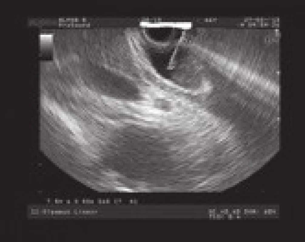 Punkce ductus choledochus.
Fig. 2. Punction of ductus choledochus.