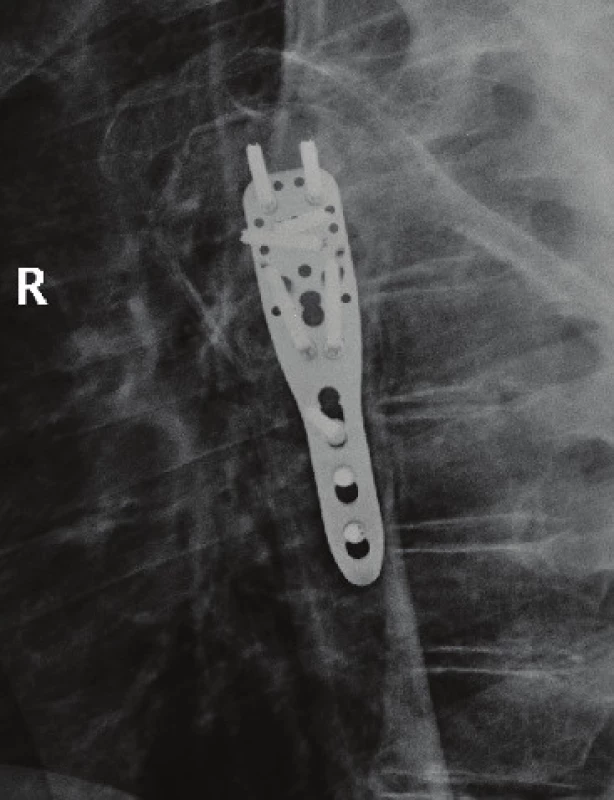 RTG obraz implantace PHILOS dlahy. RTG obraz pooperační