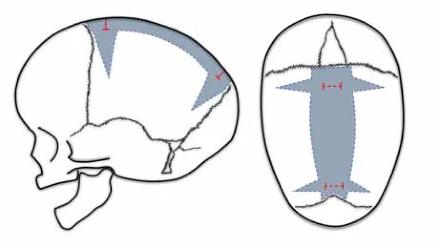 Endoscopic strip craniectomy