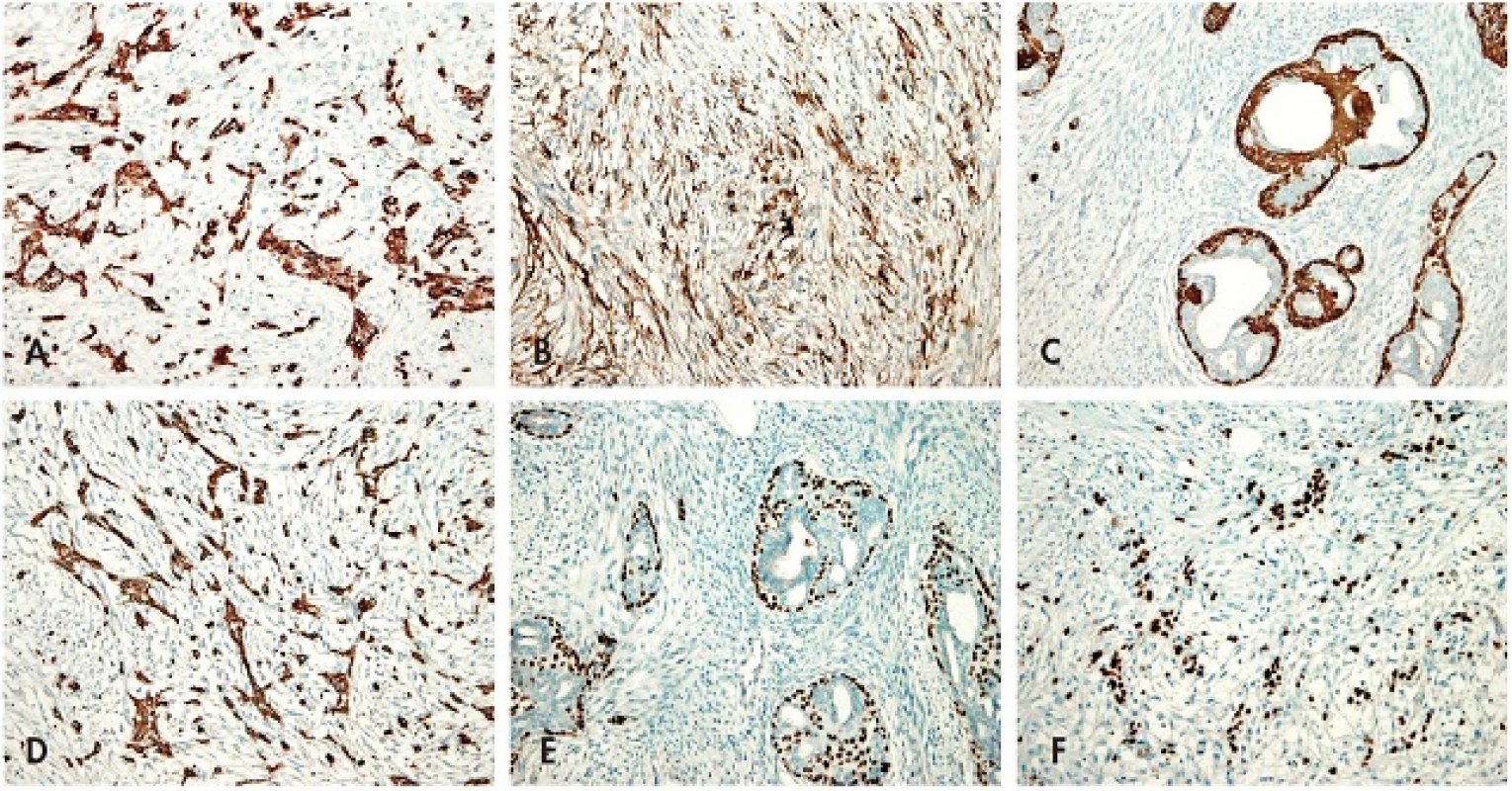 <em>Imunohistochemie</em>. A – Imunohistochemický průkaz cytokeratinu 7 v metaplastickém vřetenobuněčném karcinomu; B – Imunohistochemický průkaz CD10 proteinu v metaplastickém vřetenobuněčném karcinomu; C – Imunohistochemický průkaz cytokeratinu 14 v myoepiteliích vývodů FT, stroma je negativní; D – Imunohistochemický průkaz cytokeratinu 14 v metaplastickém vřetenobuněčném karcinomu; E – Imunohistochemický průkaz p63 v myoepiteliích vývodů FT, stroma je negativní; F – Imunohistochemický průkaz p63 v metaplastickém vřetenobuněčném karcinomu (vše zvětšení 200x).
