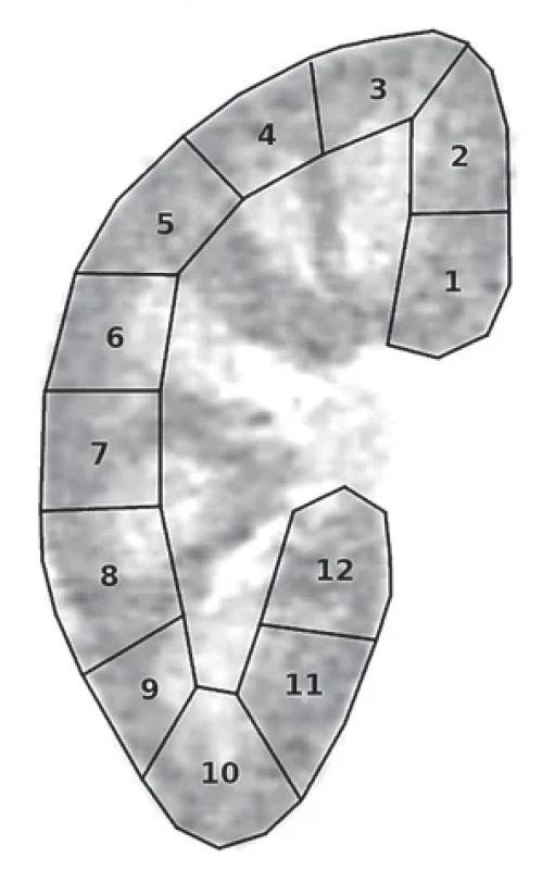 Grading 99mTc-DMSA scanu podle počtu postižených segmentů (0–12) podle Mattoo et al.(16)