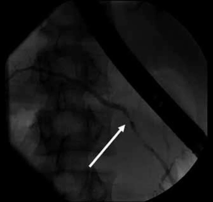 ERCP – stenóza pankreatického vývodu v místě původního defektu na přechodu hlavy a těla slinivky, pohled zezadu (šipka). 
Fig. 5. ERCP – stenosis of the pancreatic duct between the pancreatic head and body, view from behind (arrow).