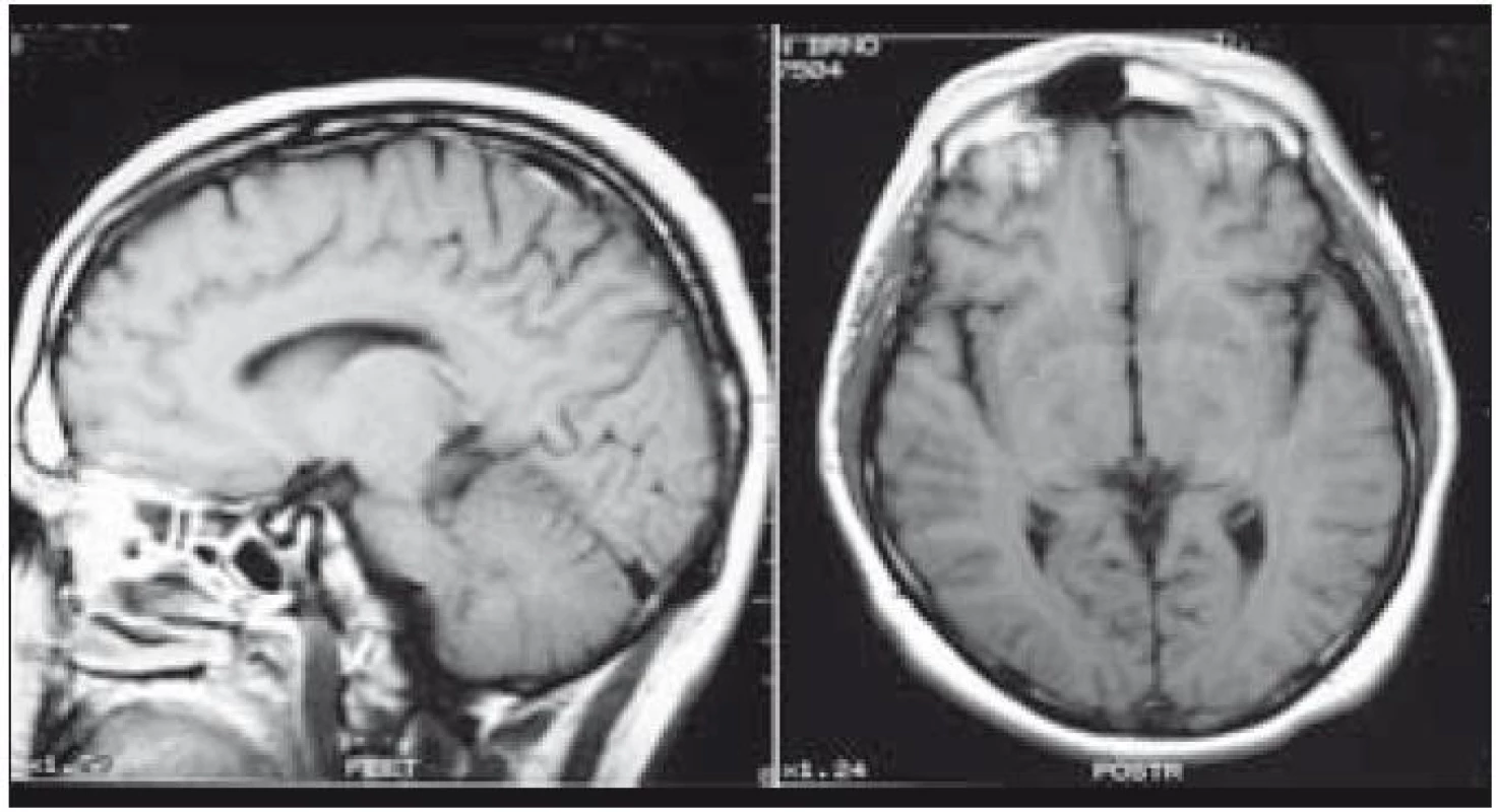 Tentýž pacient po chemoterapii, která sestávala ze stimulačního režimu etoposid + cyklosfosfosfamid se sběrem kmenových buněk krvetvorby z periferní krve, a následujících 4 cyklech 2- CDA. Po léčbě došlo k totální regresi ložisek, remise trvá již 7. rok od ukončení léčby.