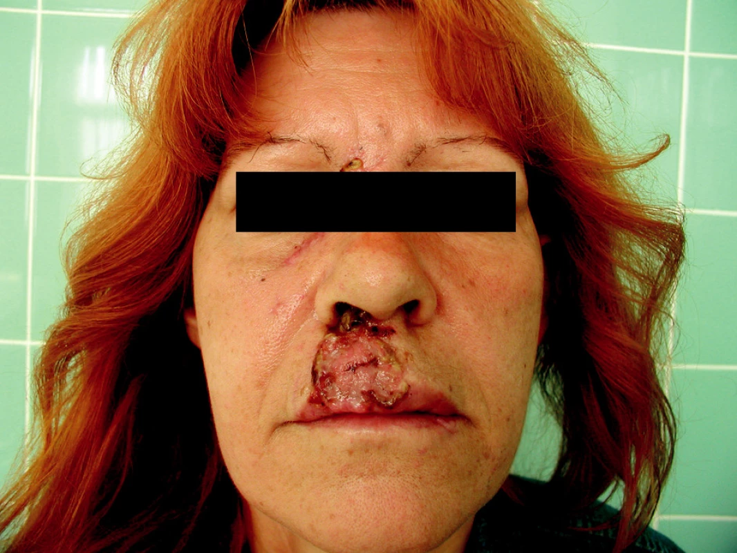 Stav před a po korekci primárně provedené transplantace ztrátového poranění horního rtu
Pic. 5. Correction of a primary transplantation of the upper lip defect injury- the pre- and postoperative condition