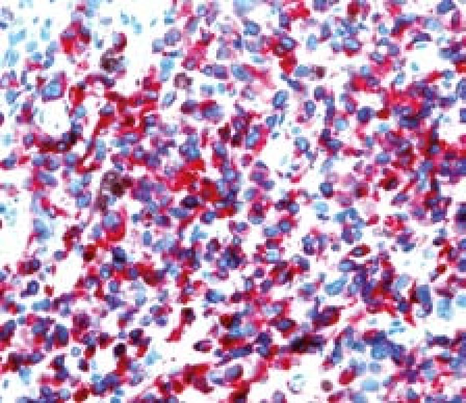 Metastáza melanomu v jejunu, kličková polpyektomie. Imunohistochemické vyšetření – Melan A pozitivita.
Fig. 8. Small bowell metastatic melanoma, snare polypectomy. Imunohistochemy – melan A positivity.