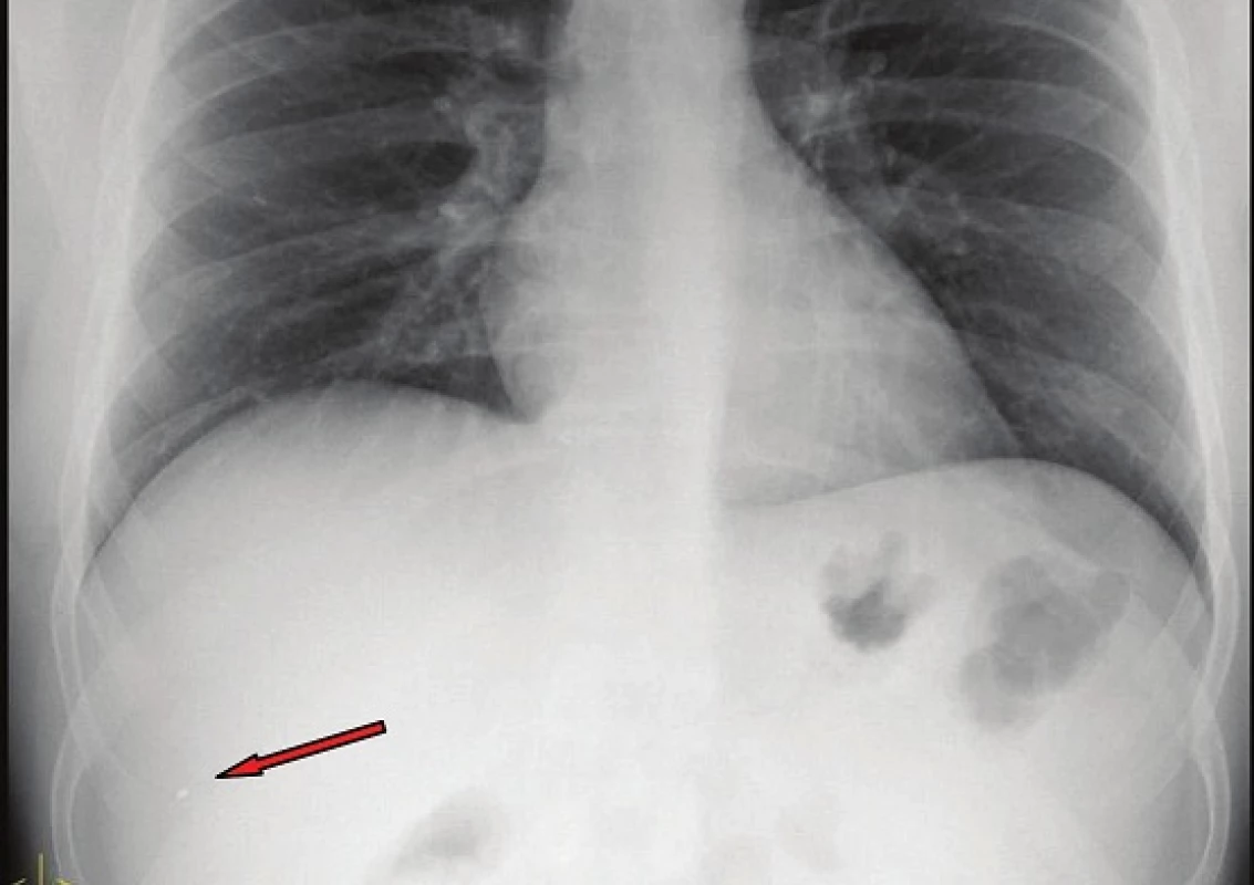 RTG hrudníku: hyperdenzní struktura zobrazena v oblasti pravého hypochondria, promítá se laterálně i dorzálně
Fig. 2: Chest X-ray: hyperdense structure located in the area of the right hypochondrium, projecting in both lateral and dorsal directions