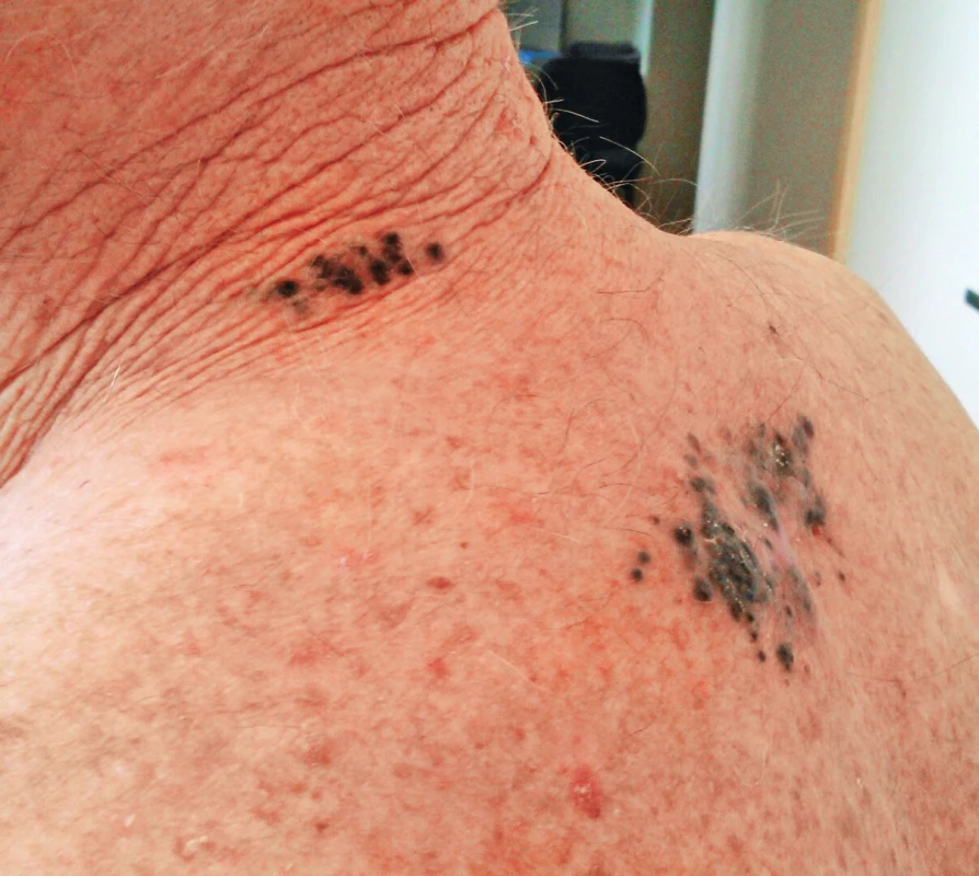 Satellite metastases around the scar after excision of melanoma in the interscapular area; in-transit metastases in the area of the neck dorsally on the left side