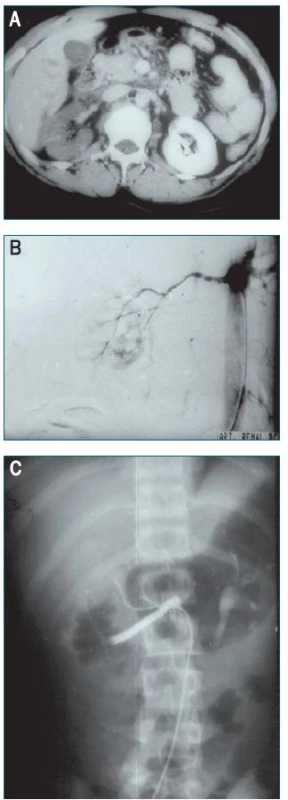 A–C. Endovaskulární stent trombotické arterie vyvolané poraněním močové trubice natažením představuje adekvátní terapeutickou modalitu, pakliže je provedeno během prvních čtyř hodin po poranění.
A. CT nález trombózy pravé renální arterie.
B. Arteriografie zobrazující parciální trombózu pravé renální arterie způsobené přerušením intimy.
C. Arteriografie ledviny zobrazující úplnou trombózu pravé renální arterie.