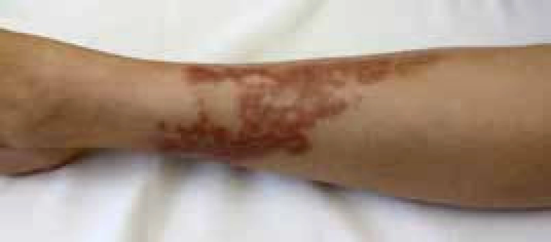 Necrobiosis lipoidica diabeticorum u pacientky s DM pôvodne juvenilným