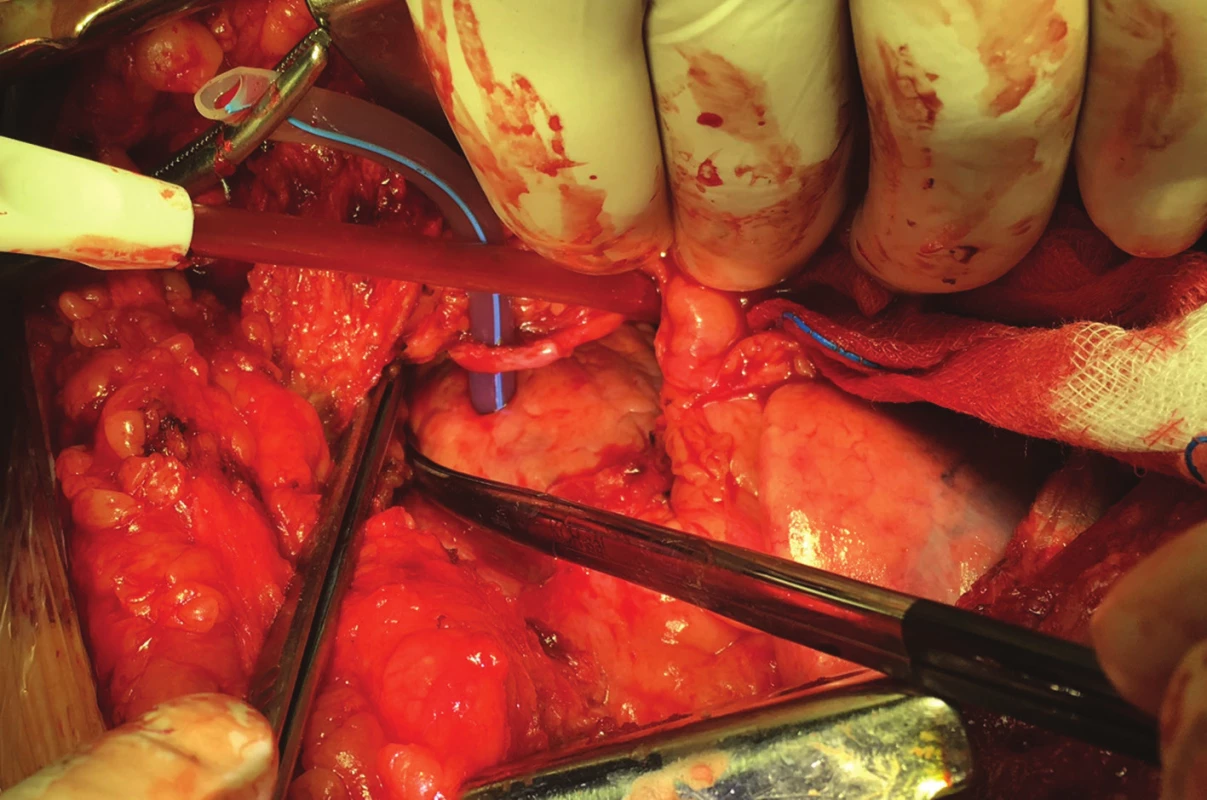 Drén po otevření perikardu prochází stěnou srdeční komory
Fig. 4: Drain passes through the wall of the ventricle after opening the pericardium