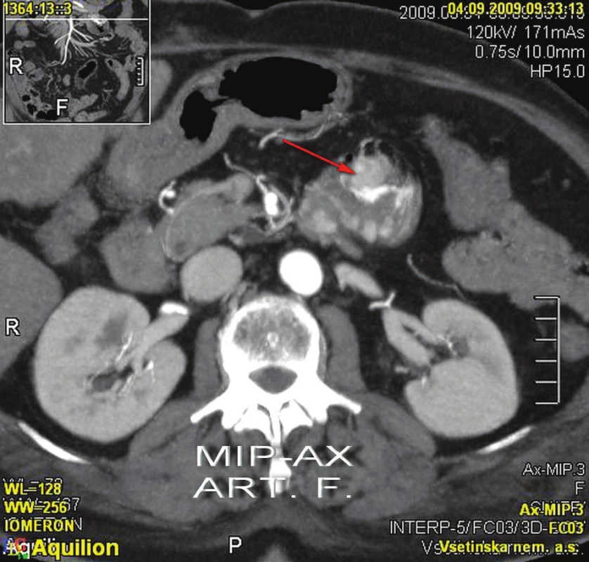 CT kontrast – krvácení z tumoru
Fig. 3: Enhanced CT – bleeding from the tumour