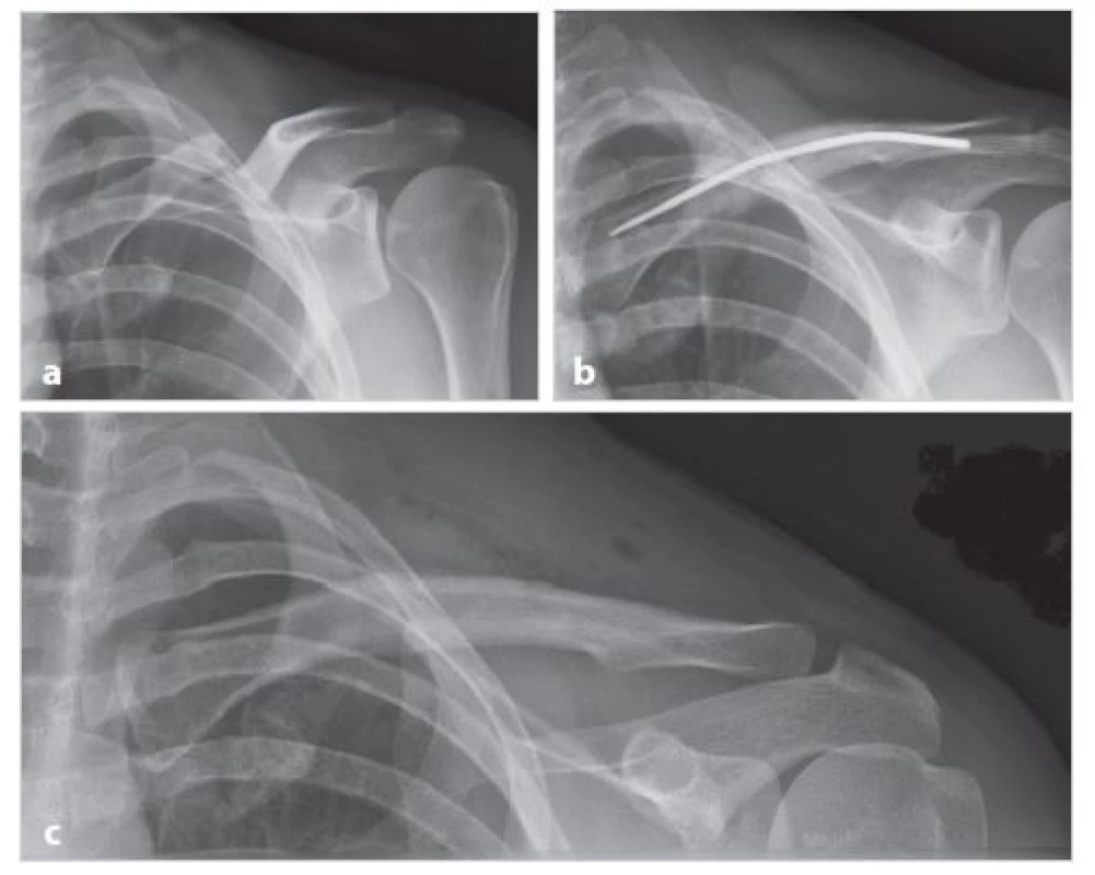 Dobré hojení při stabilizaci zlomeniny anulovaným implantátem (muž P. H., 29 let)
a) úrazové snímky dvoufragmentové zlomeniny klíční kosti; b) tři měsíce po operaci s nálezem angulovaného implantátu; c) stav po zhojení zlomeniny a extrakci osteosyntetického materiálu v 8 měsících od úrazu
Fig. 4: Good fracture healing by stabilization with bending of implant (male P.H., 29 years)
a) X-ray of a two-fragment fracture taken after the injury; b) three months after the surgery showing bent implant; c) the condition after healing of the fracture and extraction of the osteosynthetic material at eight months from the accident