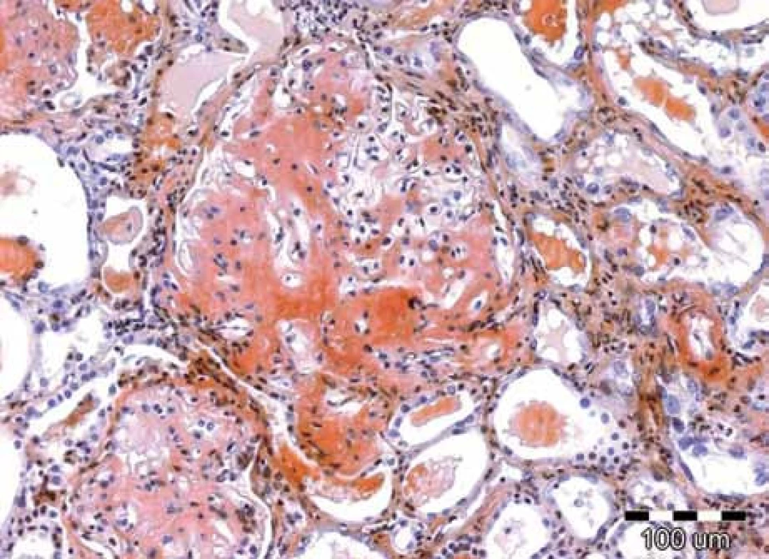 Speciální barvení tkáňových řezů konžskou červení prokazuje kongofilní depozita v glomerulu, zbarvená cihlově červeně. Původní zvětšení 100krát.
